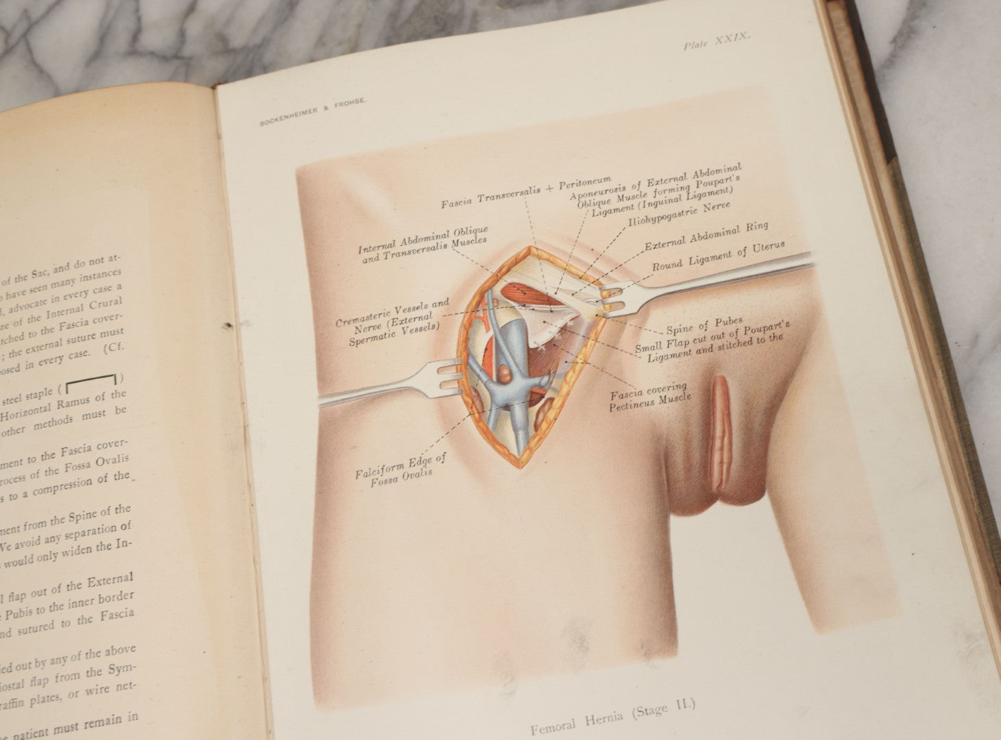 Lot 002 - "Atlas Of Typical Operations In Surgery" Antique Book By Dr. Ph. Bockenheimer & Dr. Fritz Frohse, With 60 Full Color Illustrations By Franz Frohse, English Adaptation By J. Howell Evans, Rebman Company, New York, Publishers, Circa 1900