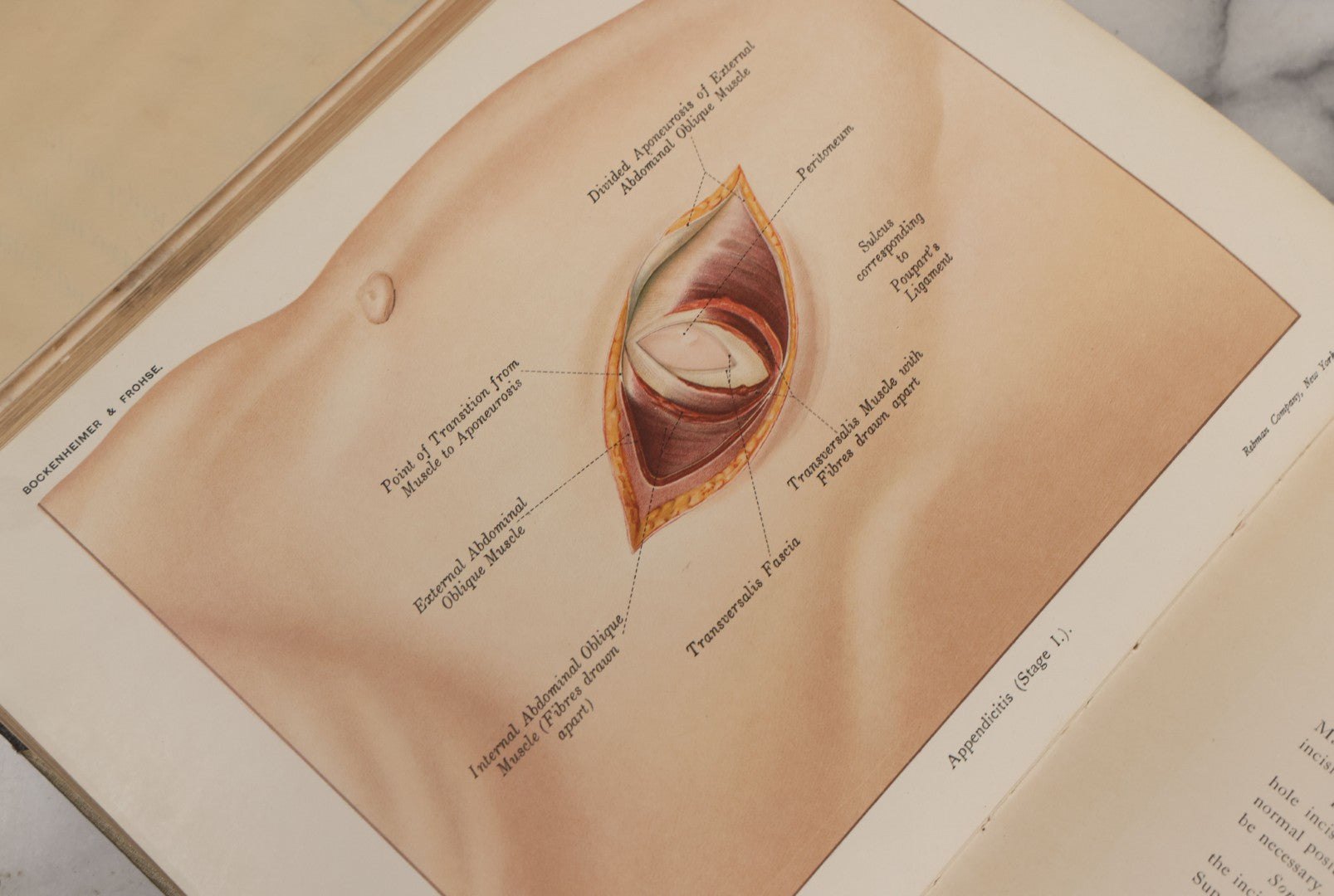 Lot 002 - "Atlas Of Typical Operations In Surgery" Antique Book By Dr. Ph. Bockenheimer & Dr. Fritz Frohse, With 60 Full Color Illustrations By Franz Frohse, English Adaptation By J. Howell Evans, Rebman Company, New York, Publishers, Circa 1900