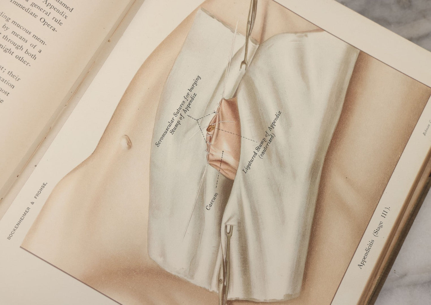 Lot 002 - "Atlas Of Typical Operations In Surgery" Antique Book By Dr. Ph. Bockenheimer & Dr. Fritz Frohse, With 60 Full Color Illustrations By Franz Frohse, English Adaptation By J. Howell Evans, Rebman Company, New York, Publishers, Circa 1900