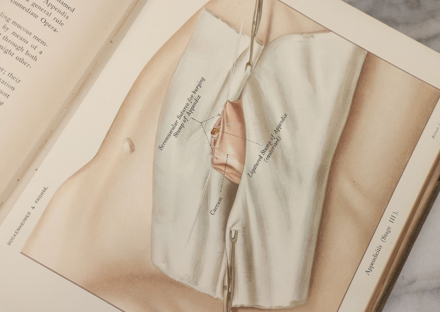 Lot 002 - "Atlas Of Typical Operations In Surgery" Antique Book By Dr. Ph. Bockenheimer & Dr. Fritz Frohse, With 60 Full Color Illustrations By Franz Frohse, English Adaptation By J. Howell Evans, Rebman Company, New York, Publishers, Circa 1900