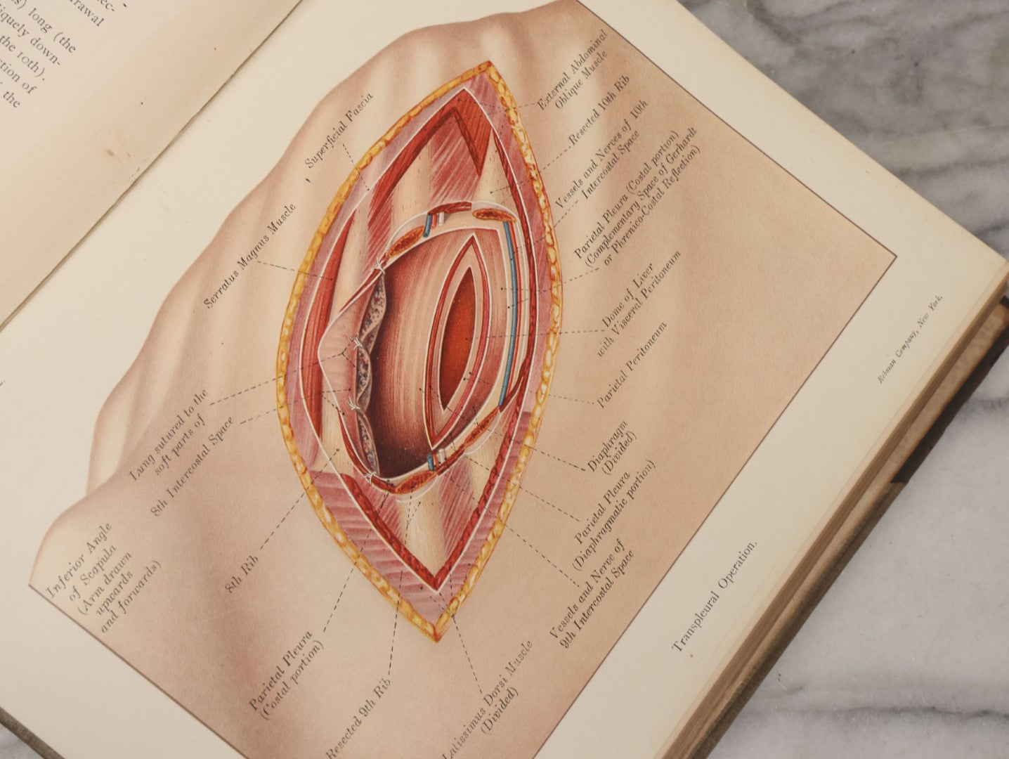 Lot 002 - "Atlas Of Typical Operations In Surgery" Antique Book By Dr. Ph. Bockenheimer & Dr. Fritz Frohse, With 60 Full Color Illustrations By Franz Frohse, English Adaptation By J. Howell Evans, Rebman Company, New York, Publishers, Circa 1900