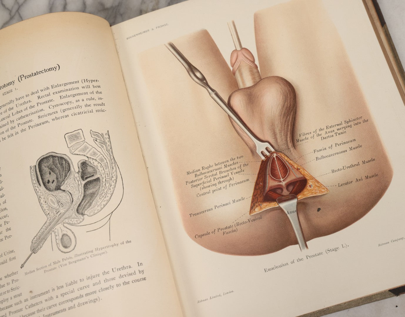 Lot 002 - "Atlas Of Typical Operations In Surgery" Antique Book By Dr. Ph. Bockenheimer & Dr. Fritz Frohse, With 60 Full Color Illustrations By Franz Frohse, English Adaptation By J. Howell Evans, Rebman Company, New York, Publishers, Circa 1900