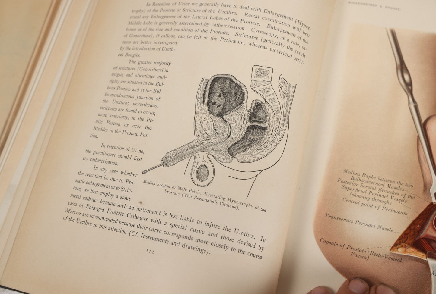 Lot 002 - "Atlas Of Typical Operations In Surgery" Antique Book By Dr. Ph. Bockenheimer & Dr. Fritz Frohse, With 60 Full Color Illustrations By Franz Frohse, English Adaptation By J. Howell Evans, Rebman Company, New York, Publishers, Circa 1900