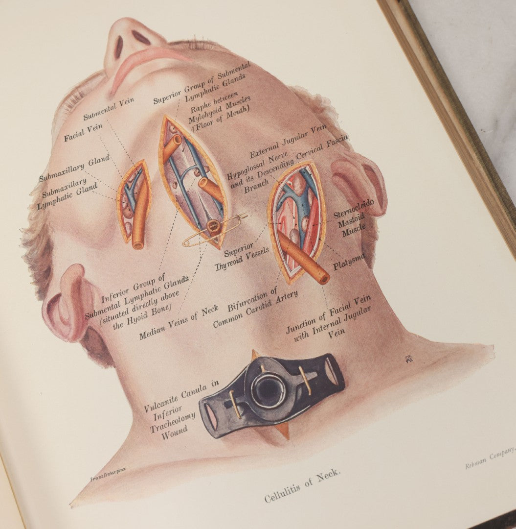 Lot 002 - "Atlas Of Typical Operations In Surgery" Antique Book By Dr. Ph. Bockenheimer & Dr. Fritz Frohse, With 60 Full Color Illustrations By Franz Frohse, English Adaptation By J. Howell Evans, Rebman Company, New York, Publishers, Circa 1900
