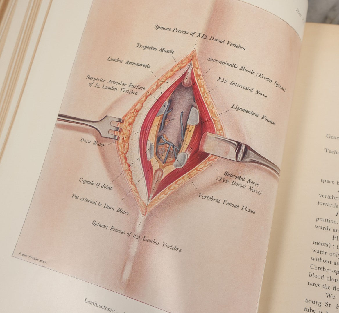 Lot 002 - "Atlas Of Typical Operations In Surgery" Antique Book By Dr. Ph. Bockenheimer & Dr. Fritz Frohse, With 60 Full Color Illustrations By Franz Frohse, English Adaptation By J. Howell Evans, Rebman Company, New York, Publishers, Circa 1900