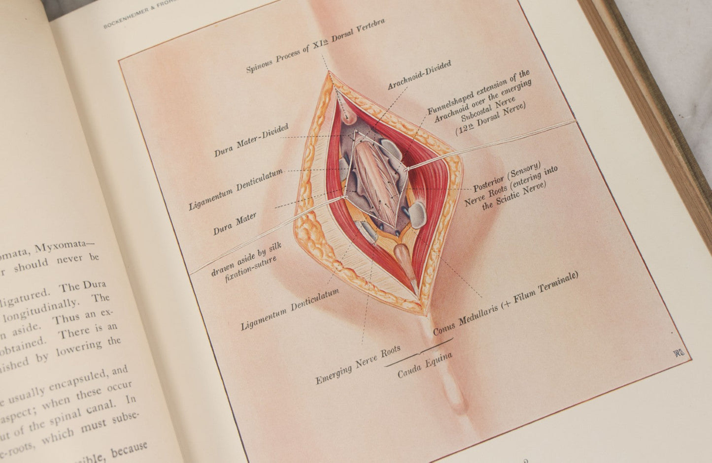 Lot 002 - "Atlas Of Typical Operations In Surgery" Antique Book By Dr. Ph. Bockenheimer & Dr. Fritz Frohse, With 60 Full Color Illustrations By Franz Frohse, English Adaptation By J. Howell Evans, Rebman Company, New York, Publishers, Circa 1900