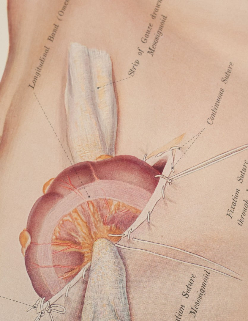 Lot 002 - "Atlas Of Typical Operations In Surgery" Antique Book By Dr. Ph. Bockenheimer & Dr. Fritz Frohse, With 60 Full Color Illustrations By Franz Frohse, English Adaptation By J. Howell Evans, Rebman Company, New York, Publishers, Circa 1900