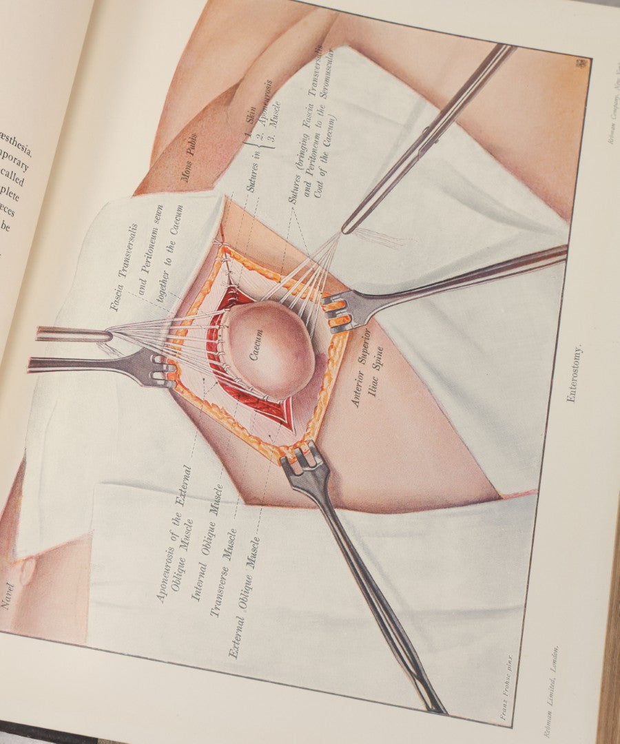 Lot 002 - "Atlas Of Typical Operations In Surgery" Antique Book By Dr. Ph. Bockenheimer & Dr. Fritz Frohse, With 60 Full Color Illustrations By Franz Frohse, English Adaptation By J. Howell Evans, Rebman Company, New York, Publishers, Circa 1900