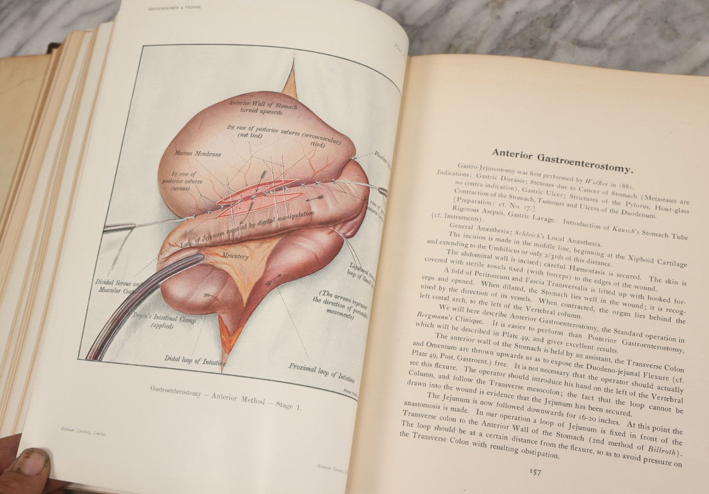 Lot 002 - "Atlas Of Typical Operations In Surgery" Antique Book By Dr. Ph. Bockenheimer & Dr. Fritz Frohse, With 60 Full Color Illustrations By Franz Frohse, English Adaptation By J. Howell Evans, Rebman Company, New York, Publishers, Circa 1900