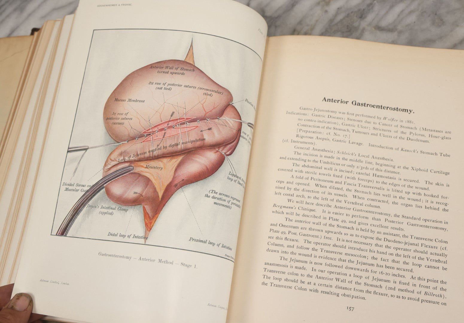 Lot 002 - "Atlas Of Typical Operations In Surgery" Antique Book By Dr. Ph. Bockenheimer & Dr. Fritz Frohse, With 60 Full Color Illustrations By Franz Frohse, English Adaptation By J. Howell Evans, Rebman Company, New York, Publishers, Circa 1900