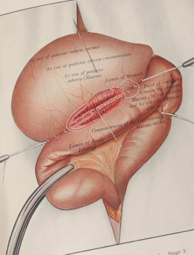 Lot 002 - "Atlas Of Typical Operations In Surgery" Antique Book By Dr. Ph. Bockenheimer & Dr. Fritz Frohse, With 60 Full Color Illustrations By Franz Frohse, English Adaptation By J. Howell Evans, Rebman Company, New York, Publishers, Circa 1900