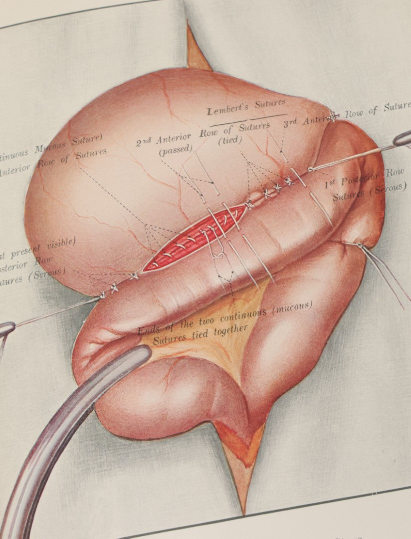 Lot 002 - "Atlas Of Typical Operations In Surgery" Antique Book By Dr. Ph. Bockenheimer & Dr. Fritz Frohse, With 60 Full Color Illustrations By Franz Frohse, English Adaptation By J. Howell Evans, Rebman Company, New York, Publishers, Circa 1900