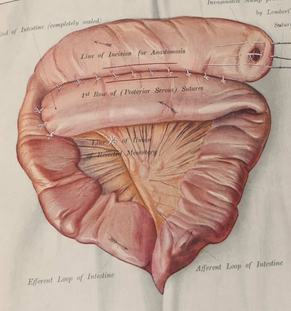 Lot 002 - "Atlas Of Typical Operations In Surgery" Antique Book By Dr. Ph. Bockenheimer & Dr. Fritz Frohse, With 60 Full Color Illustrations By Franz Frohse, English Adaptation By J. Howell Evans, Rebman Company, New York, Publishers, Circa 1900
