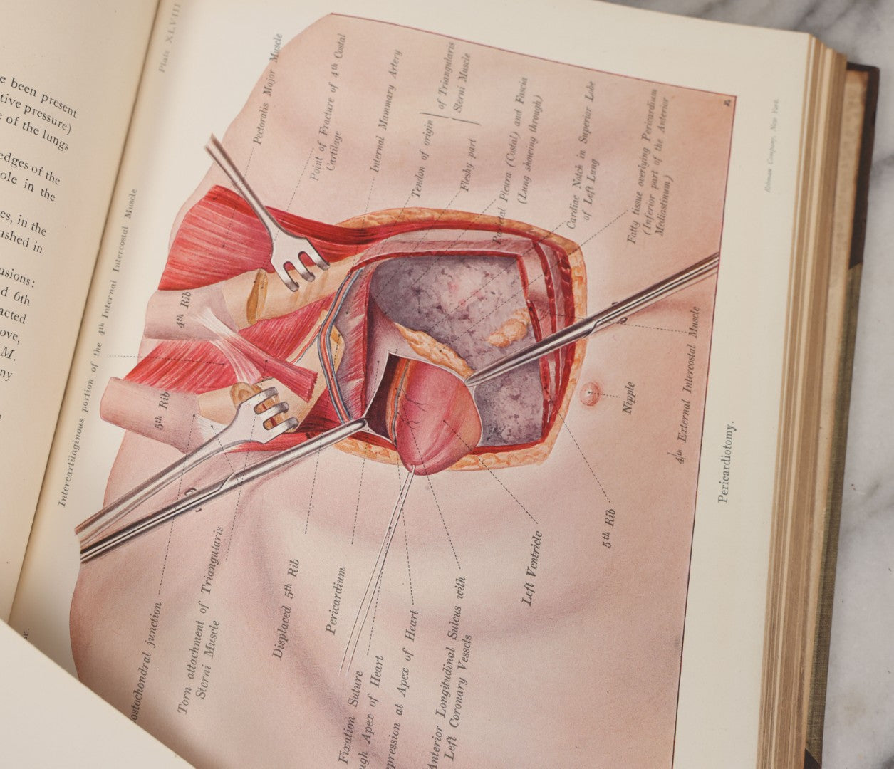Lot 002 - "Atlas Of Typical Operations In Surgery" Antique Book By Dr. Ph. Bockenheimer & Dr. Fritz Frohse, With 60 Full Color Illustrations By Franz Frohse, English Adaptation By J. Howell Evans, Rebman Company, New York, Publishers, Circa 1900