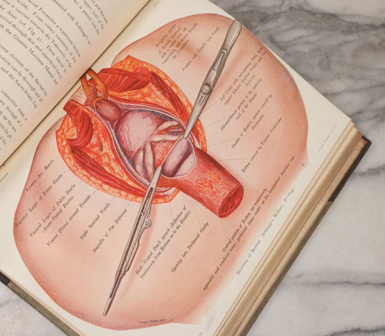 Lot 002 - "Atlas Of Typical Operations In Surgery" Antique Book By Dr. Ph. Bockenheimer & Dr. Fritz Frohse, With 60 Full Color Illustrations By Franz Frohse, English Adaptation By J. Howell Evans, Rebman Company, New York, Publishers, Circa 1900