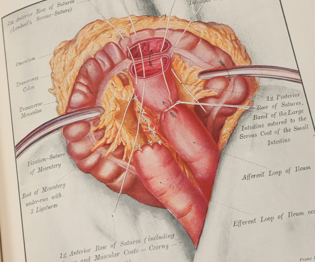 Lot 002 - "Atlas Of Typical Operations In Surgery" Antique Book By Dr. Ph. Bockenheimer & Dr. Fritz Frohse, With 60 Full Color Illustrations By Franz Frohse, English Adaptation By J. Howell Evans, Rebman Company, New York, Publishers, Circa 1900