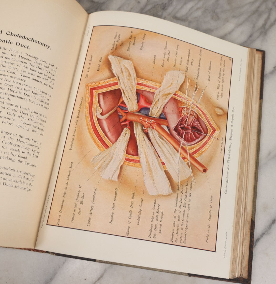 Lot 002 - "Atlas Of Typical Operations In Surgery" Antique Book By Dr. Ph. Bockenheimer & Dr. Fritz Frohse, With 60 Full Color Illustrations By Franz Frohse, English Adaptation By J. Howell Evans, Rebman Company, New York, Publishers, Circa 1900