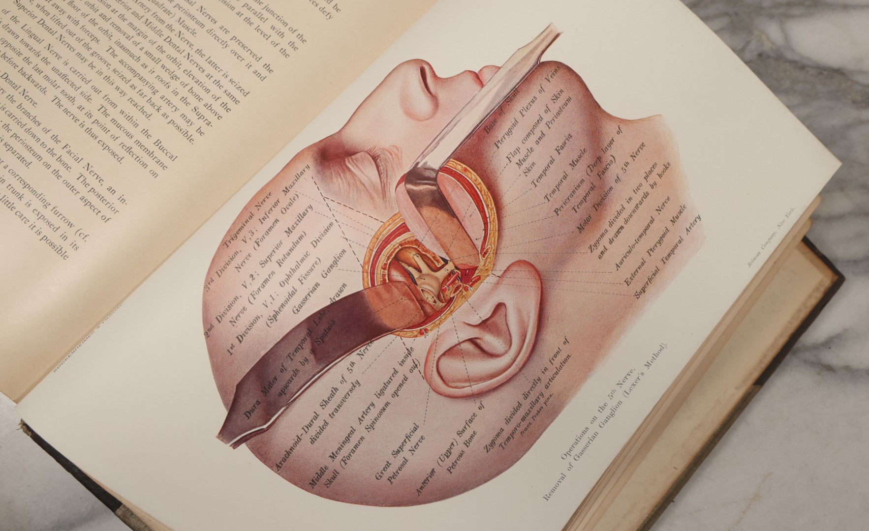 Lot 002 - "Atlas Of Typical Operations In Surgery" Antique Book By Dr. Ph. Bockenheimer & Dr. Fritz Frohse, With 60 Full Color Illustrations By Franz Frohse, English Adaptation By J. Howell Evans, Rebman Company, New York, Publishers, Circa 1900