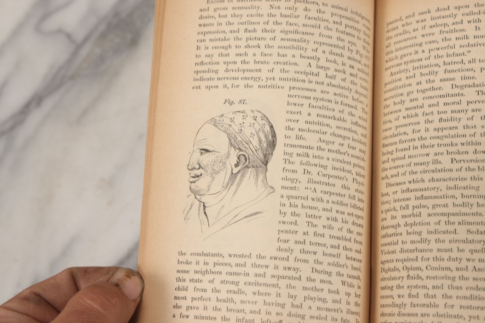 Lot 003 - "The People's Common Sense Medical Adviser In Plain English; Or Medicine Simplified" Antique Book By R.V. Pierce, M.D., 21st Edition, Illustrated, 1889