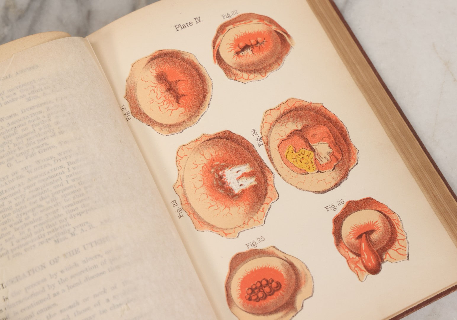 Lot 003 - "The People's Common Sense Medical Adviser In Plain English; Or Medicine Simplified" Antique Book By R.V. Pierce, M.D., 21st Edition, Illustrated, 1889