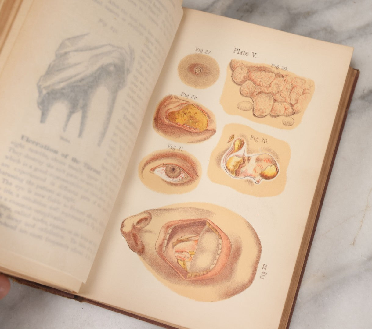 Lot 003 - "The People's Common Sense Medical Adviser In Plain English; Or Medicine Simplified" Antique Book By R.V. Pierce, M.D., 21st Edition, Illustrated, 1889