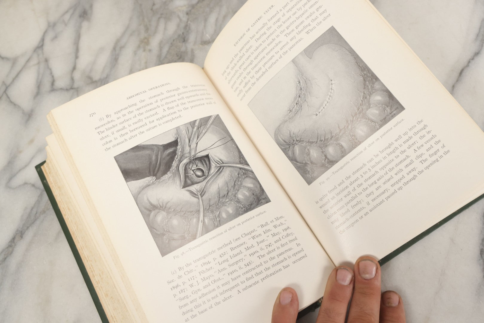 Lot 106 - "Abdominal Operations, Volume I" Antique Medical Textbook By Sir Berkeley Moynihan, Third Edition, Revised, Fully Illustrated, W.B. Saunders Company, Publisher, Philadelphia And London, 1914