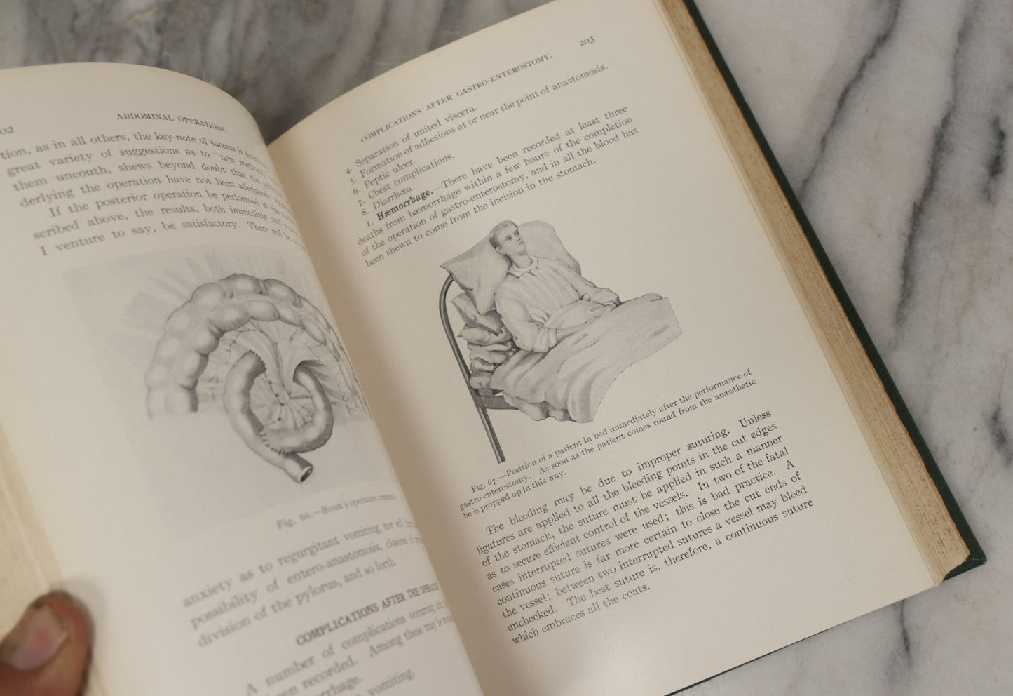 Lot 106 - "Abdominal Operations, Volume I" Antique Medical Textbook By Sir Berkeley Moynihan, Third Edition, Revised, Fully Illustrated, W.B. Saunders Company, Publisher, Philadelphia And London, 1914