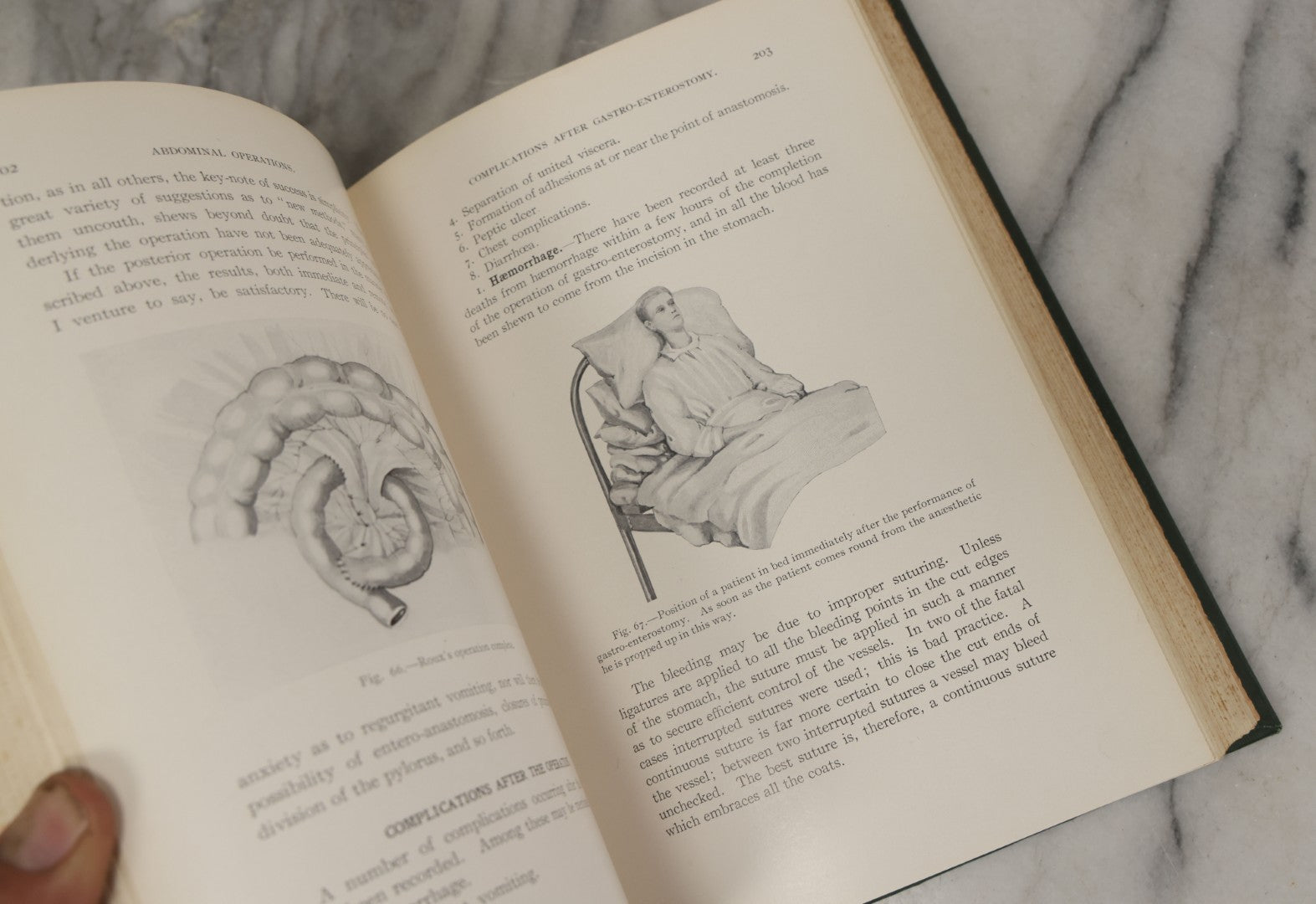Lot 106 - "Abdominal Operations, Volume I" Antique Medical Textbook By Sir Berkeley Moynihan, Third Edition, Revised, Fully Illustrated, W.B. Saunders Company, Publisher, Philadelphia And London, 1914