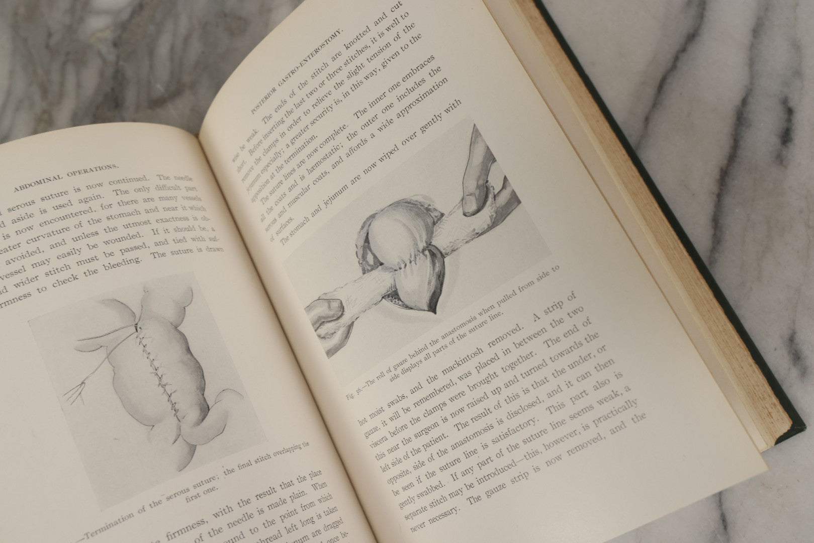 Lot 106 - "Abdominal Operations, Volume I" Antique Medical Textbook By Sir Berkeley Moynihan, Third Edition, Revised, Fully Illustrated, W.B. Saunders Company, Publisher, Philadelphia And London, 1914