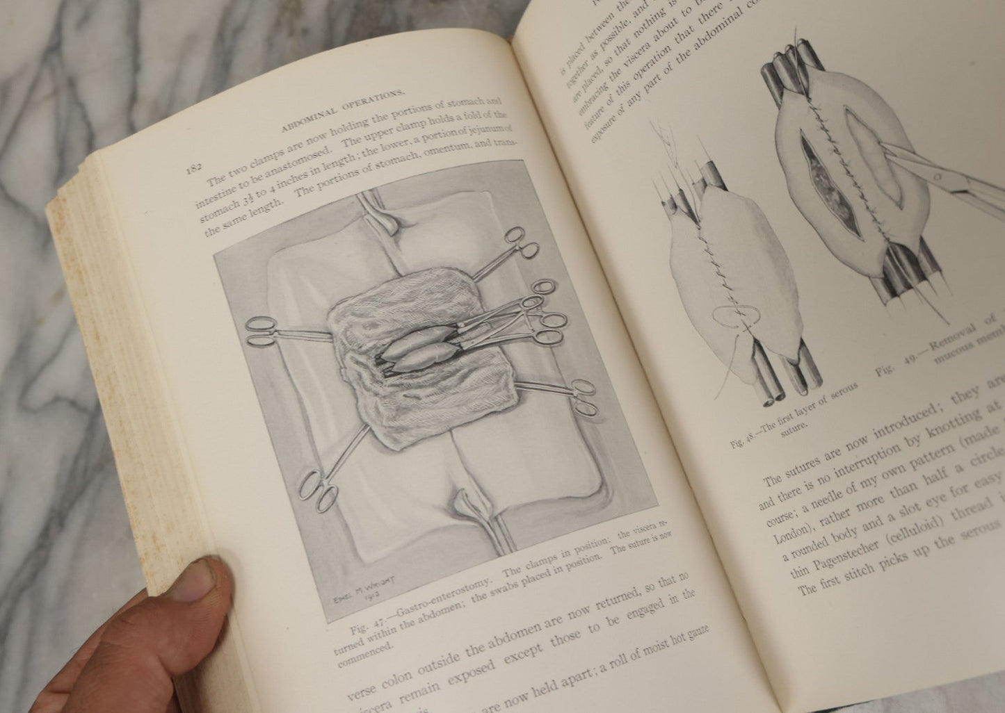 Lot 106 - "Abdominal Operations, Volume I" Antique Medical Textbook By Sir Berkeley Moynihan, Third Edition, Revised, Fully Illustrated, W.B. Saunders Company, Publisher, Philadelphia And London, 1914