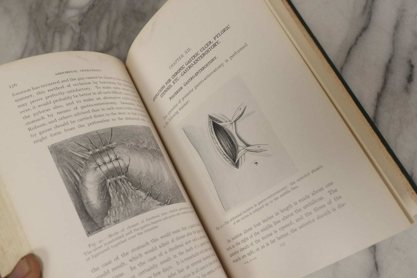 Lot 106 - "Abdominal Operations, Volume I" Antique Medical Textbook By Sir Berkeley Moynihan, Third Edition, Revised, Fully Illustrated, W.B. Saunders Company, Publisher, Philadelphia And London, 1914