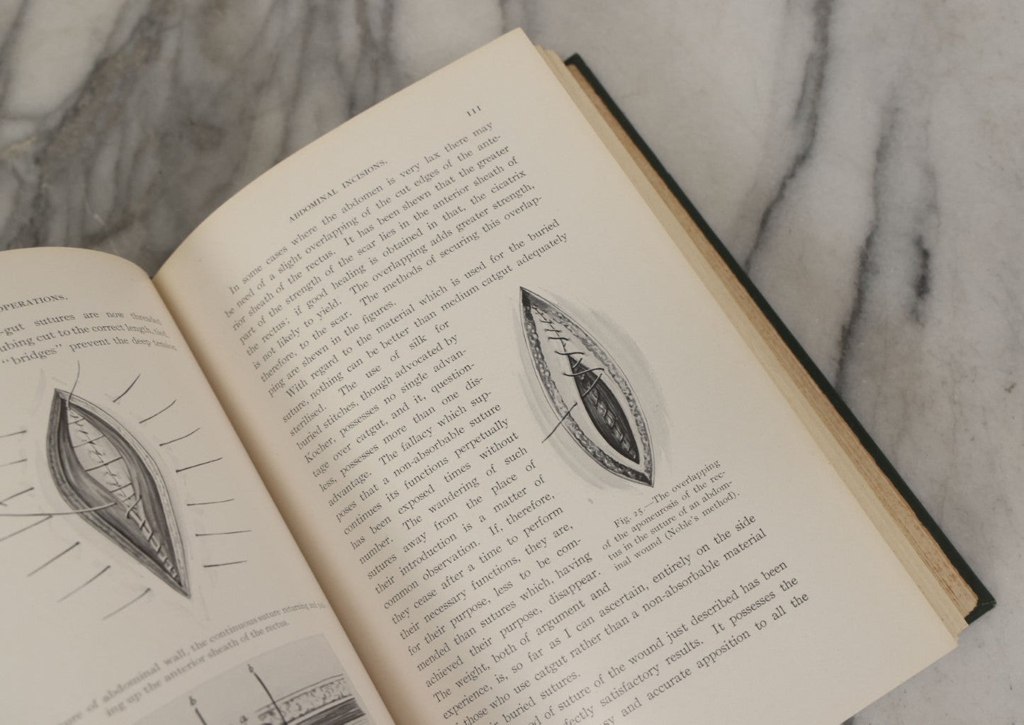 Lot 106 - "Abdominal Operations, Volume I" Antique Medical Textbook By Sir Berkeley Moynihan, Third Edition, Revised, Fully Illustrated, W.B. Saunders Company, Publisher, Philadelphia And London, 1914