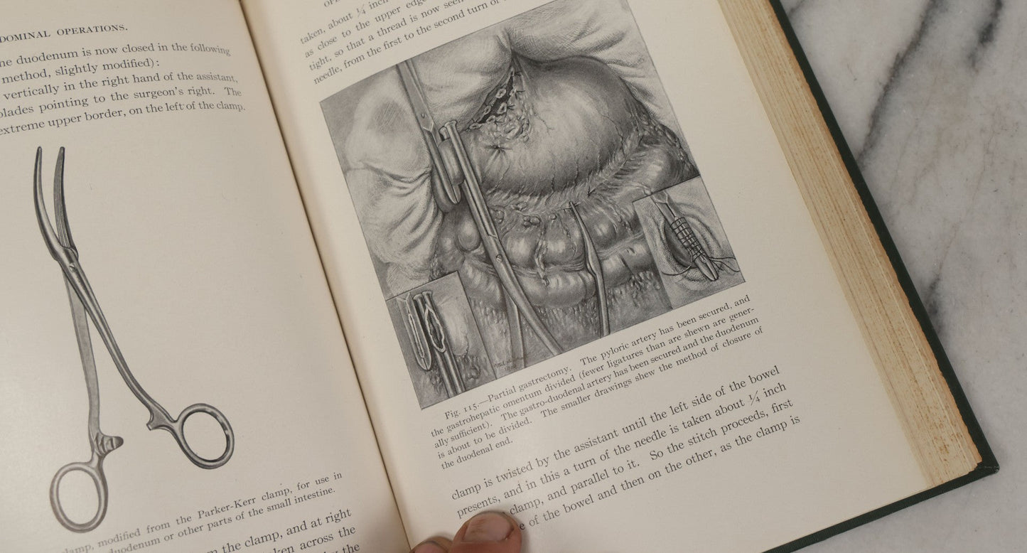 Lot 106 - "Abdominal Operations, Volume I" Antique Medical Textbook By Sir Berkeley Moynihan, Third Edition, Revised, Fully Illustrated, W.B. Saunders Company, Publisher, Philadelphia And London, 1914