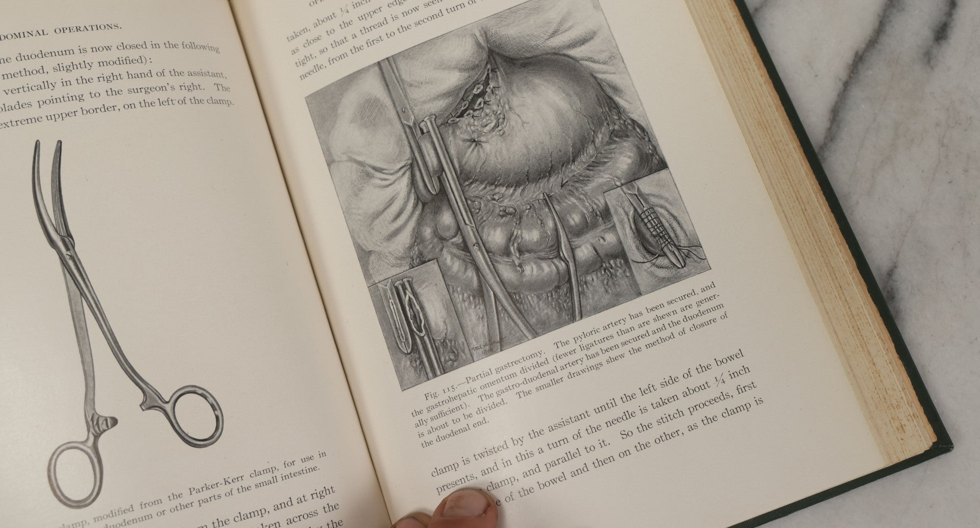 Lot 106 - "Abdominal Operations, Volume I" Antique Medical Textbook By Sir Berkeley Moynihan, Third Edition, Revised, Fully Illustrated, W.B. Saunders Company, Publisher, Philadelphia And London, 1914