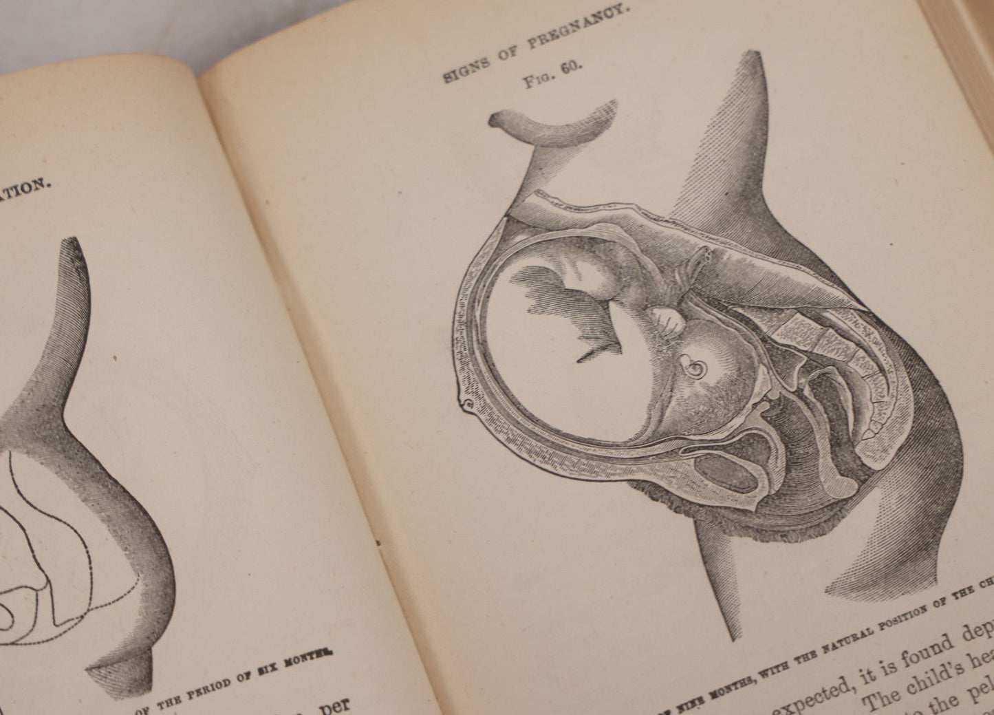 Lot 106 - "The Ladies Medical Guide" Antique Book By S. Pancoast, M.D., Illustrated With Over 100 Engravings, John E. Potter And Company, Publishers, Philadelphia, 1875