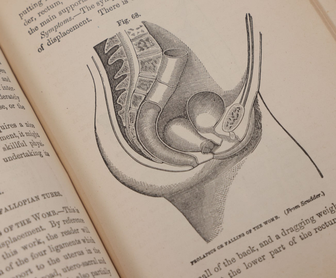 Lot 106 - "The Ladies Medical Guide" Antique Book By S. Pancoast, M.D., Illustrated With Over 100 Engravings, John E. Potter And Company, Publishers, Philadelphia, 1875