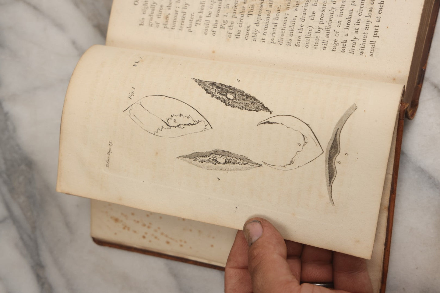 Lot 025 - "Practical Observations In Surgery, Illustrated By Cases" Early Antique Medical Surgery  Book By William Hey, Second Edition, Illustrated With Plates, T. Cadell And W. Davies, Publishers, London, 1810