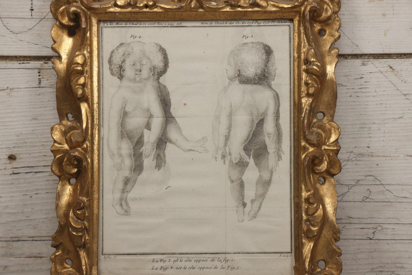 Lot 015 - Antique Anatomical Engraving Of Conjoined Twins, From Mémoires De L'Académie Royale Des Sciences, Paris, 1776, After Drawings By Fossier (Del.) And Engraved By Y. Le G. (Sc.), French Medical Illustration, Framed, 9-5/8" x 11-5/8"