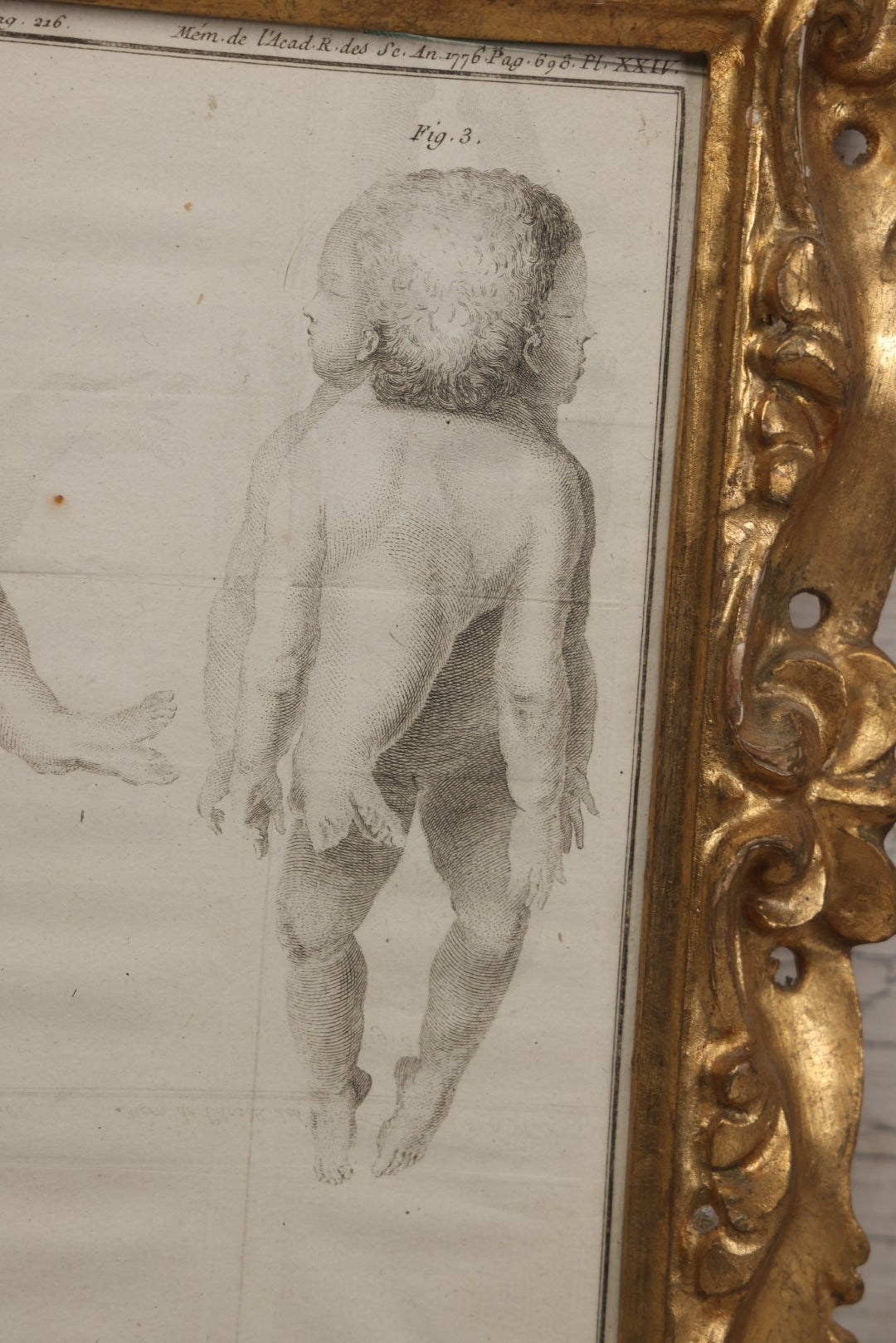 Lot 015 - Antique Anatomical Engraving Of Conjoined Twins, From Mémoires De L'Académie Royale Des Sciences, Paris, 1776, After Drawings By Fossier (Del.) And Engraved By Y. Le G. (Sc.), French Medical Illustration, Framed, 9-5/8" x 11-5/8"