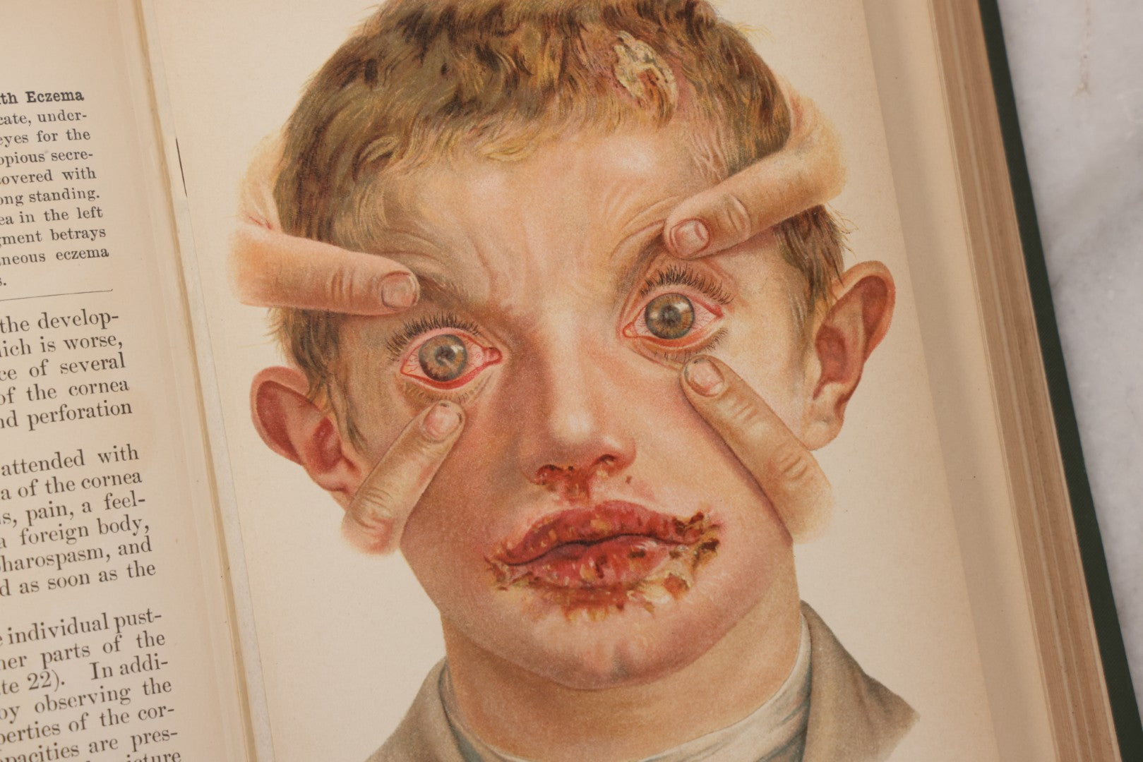 Lot 049 - "Atlas Of The External Diseases Of The Eye Including [...] Pathology And Treatment" Antique Medical Book By Prof. Dr. O. Haab, Translated From German, Illustrated With 76 Plates & 6 Engravings, Published By W.B. Saunders, Philadelphia, 1899