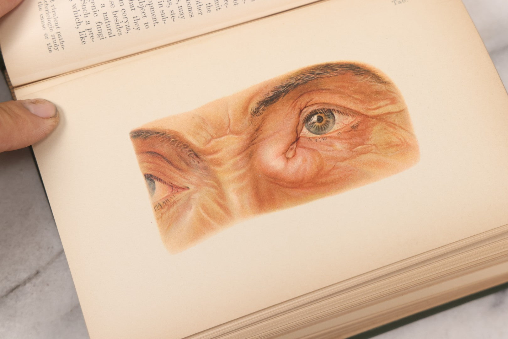 Lot 049 - "Atlas Of The External Diseases Of The Eye Including [...] Pathology And Treatment" Antique Medical Book By Prof. Dr. O. Haab, Translated From German, Illustrated With 76 Plates & 6 Engravings, Published By W.B. Saunders, Philadelphia, 1899