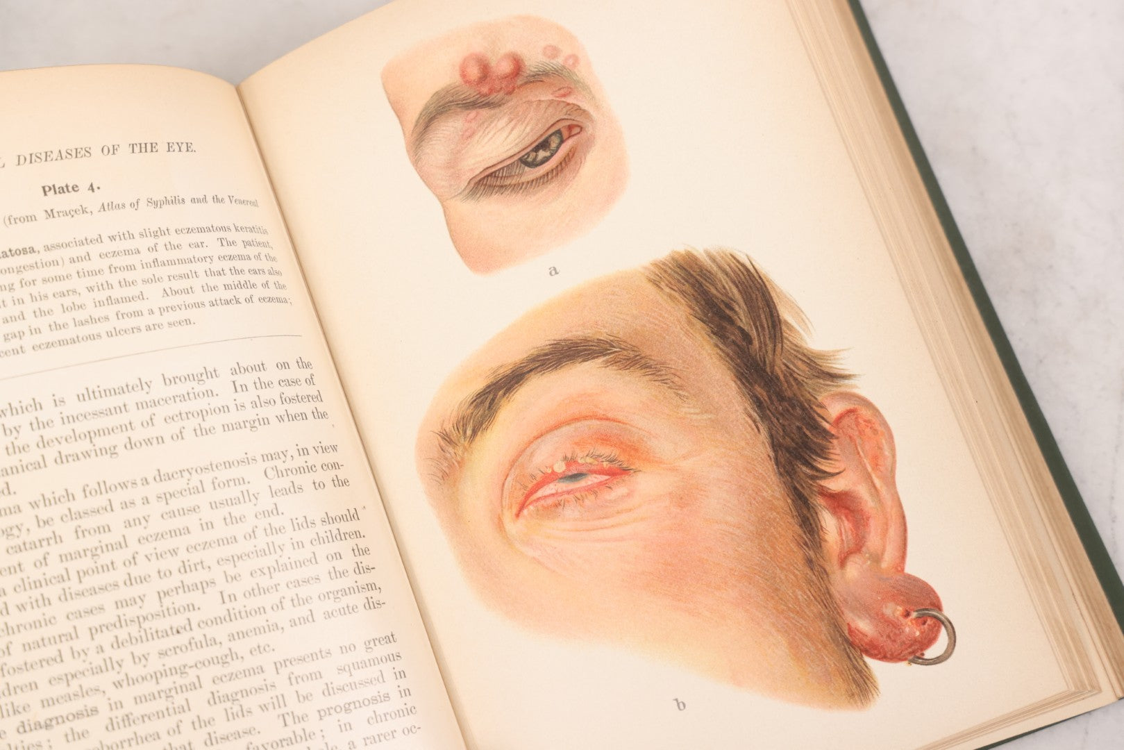 Lot 049 - "Atlas Of The External Diseases Of The Eye Including [...] Pathology And Treatment" Antique Medical Book By Prof. Dr. O. Haab, Translated From German, Illustrated With 76 Plates & 6 Engravings, Published By W.B. Saunders, Philadelphia, 1899