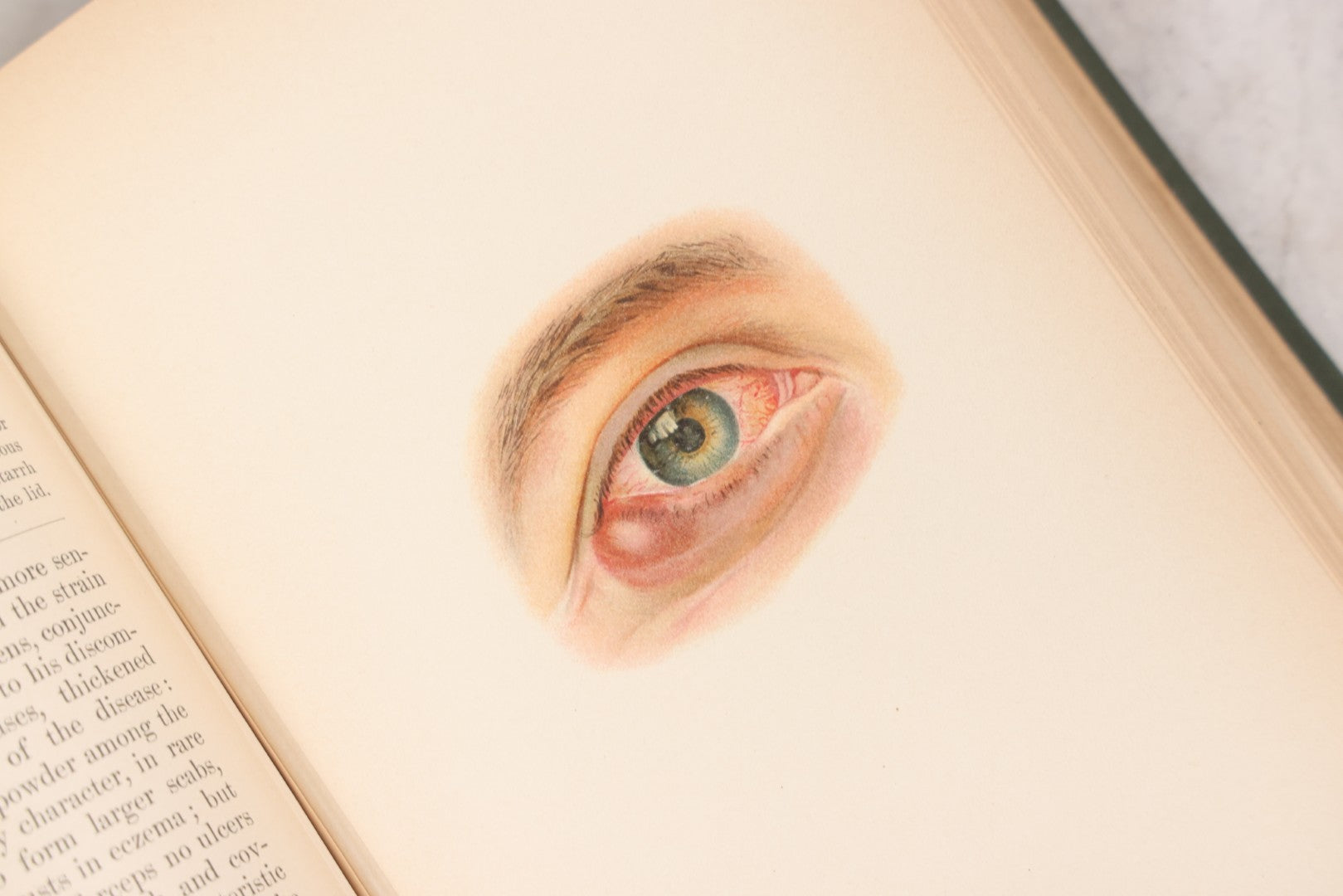 Lot 049 - "Atlas Of The External Diseases Of The Eye Including [...] Pathology And Treatment" Antique Medical Book By Prof. Dr. O. Haab, Translated From German, Illustrated With 76 Plates & 6 Engravings, Published By W.B. Saunders, Philadelphia, 1899