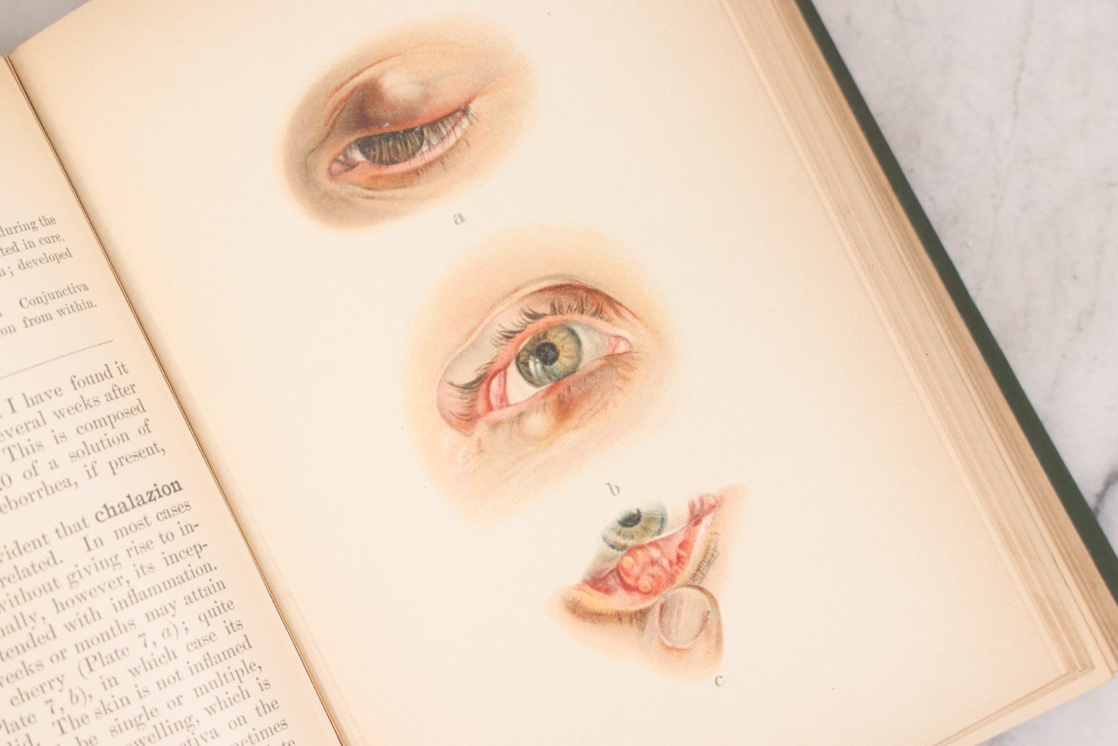 Lot 049 - "Atlas Of The External Diseases Of The Eye Including [...] Pathology And Treatment" Antique Medical Book By Prof. Dr. O. Haab, Translated From German, Illustrated With 76 Plates & 6 Engravings, Published By W.B. Saunders, Philadelphia, 1899