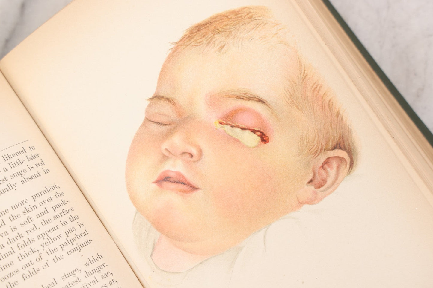 Lot 049 - "Atlas Of The External Diseases Of The Eye Including [...] Pathology And Treatment" Antique Medical Book By Prof. Dr. O. Haab, Translated From German, Illustrated With 76 Plates & 6 Engravings, Published By W.B. Saunders, Philadelphia, 1899