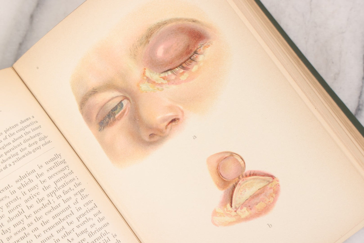 Lot 049 - "Atlas Of The External Diseases Of The Eye Including [...] Pathology And Treatment" Antique Medical Book By Prof. Dr. O. Haab, Translated From German, Illustrated With 76 Plates & 6 Engravings, Published By W.B. Saunders, Philadelphia, 1899