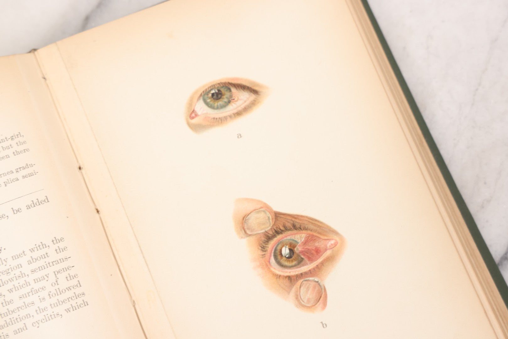 Lot 049 - "Atlas Of The External Diseases Of The Eye Including [...] Pathology And Treatment" Antique Medical Book By Prof. Dr. O. Haab, Translated From German, Illustrated With 76 Plates & 6 Engravings, Published By W.B. Saunders, Philadelphia, 1899