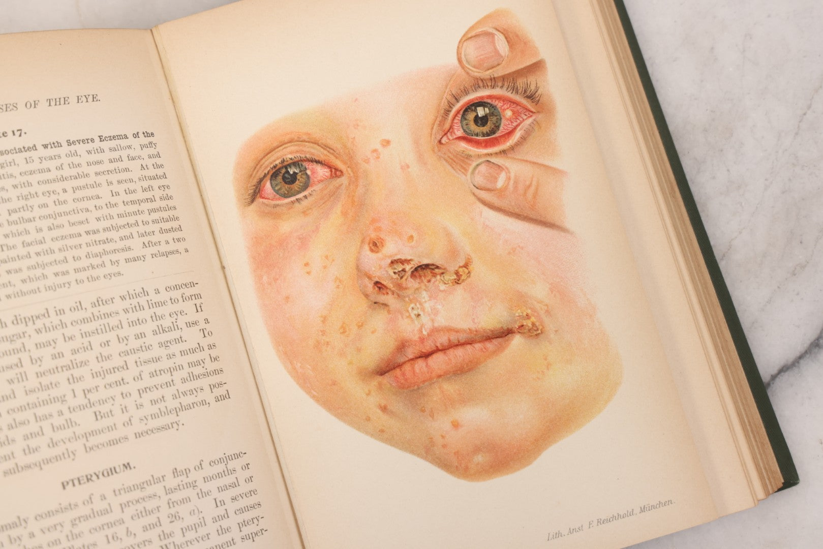 Lot 049 - "Atlas Of The External Diseases Of The Eye Including [...] Pathology And Treatment" Antique Medical Book By Prof. Dr. O. Haab, Translated From German, Illustrated With 76 Plates & 6 Engravings, Published By W.B. Saunders, Philadelphia, 1899