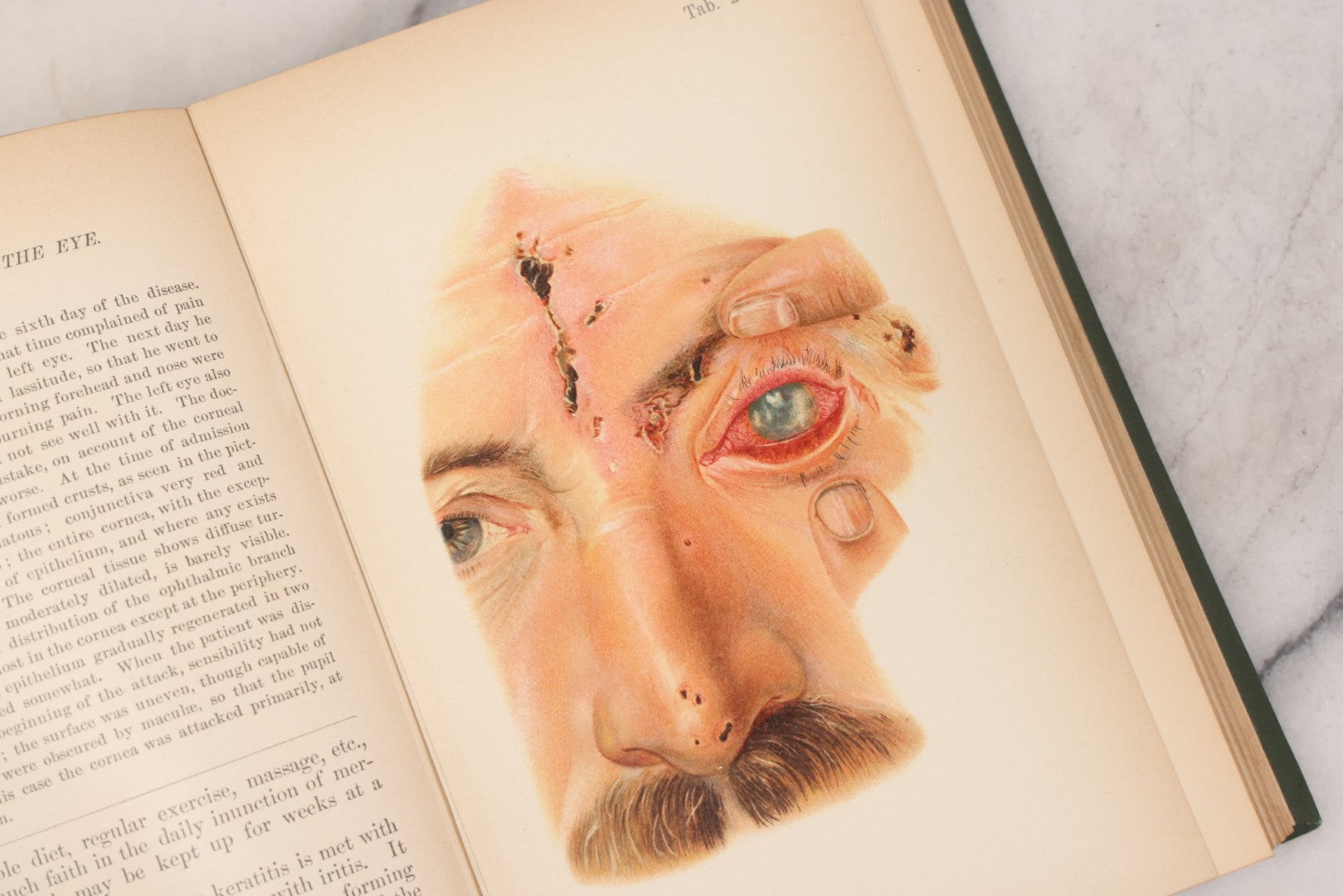 Lot 049 - "Atlas Of The External Diseases Of The Eye Including [...] Pathology And Treatment" Antique Medical Book By Prof. Dr. O. Haab, Translated From German, Illustrated With 76 Plates & 6 Engravings, Published By W.B. Saunders, Philadelphia, 1899