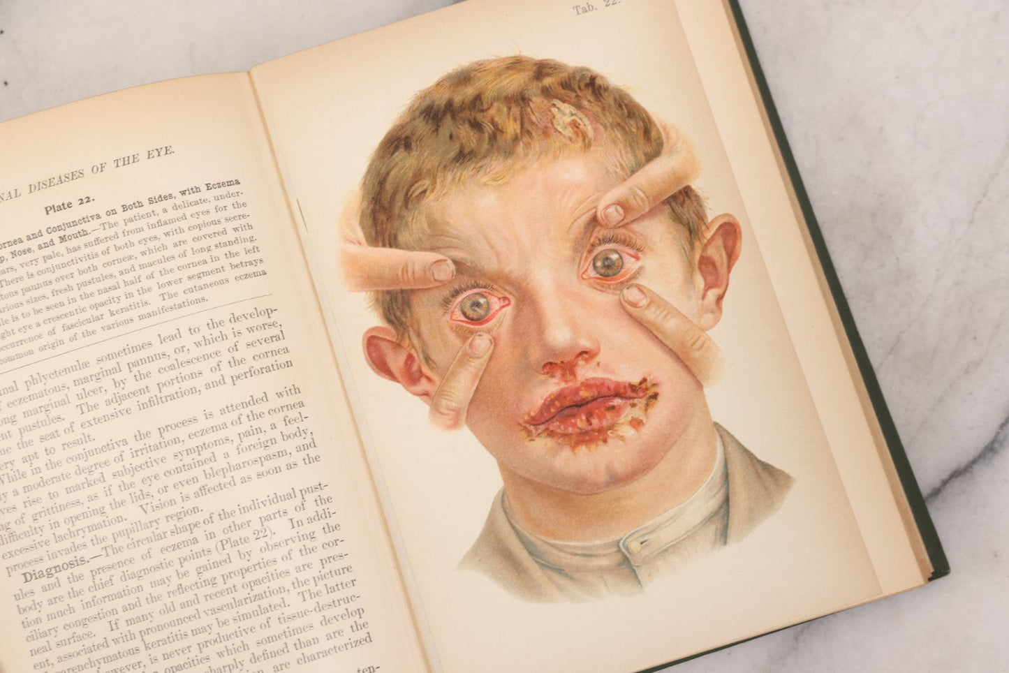 Lot 049 - "Atlas Of The External Diseases Of The Eye Including [...] Pathology And Treatment" Antique Medical Book By Prof. Dr. O. Haab, Translated From German, Illustrated With 76 Plates & 6 Engravings, Published By W.B. Saunders, Philadelphia, 1899